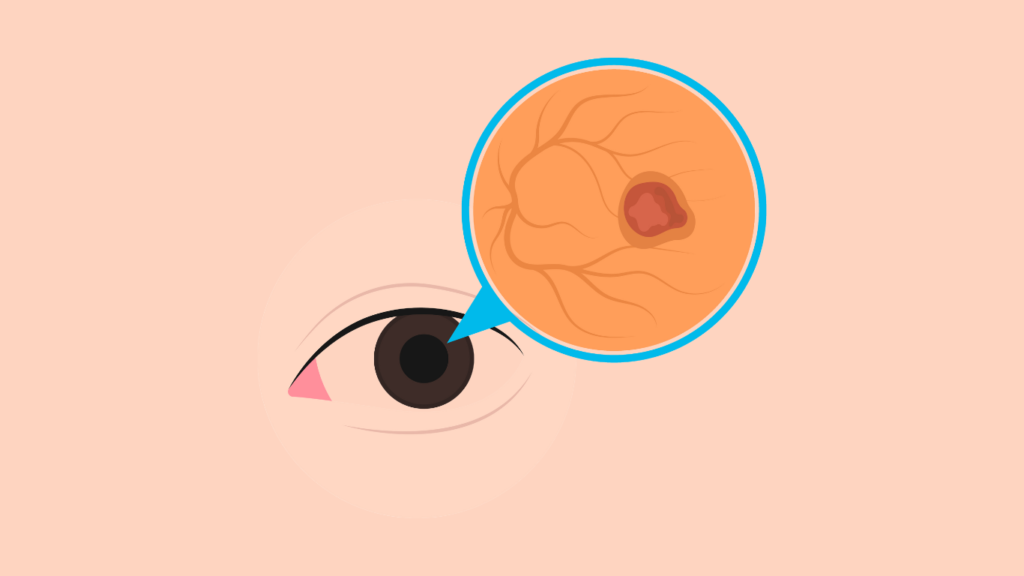 Diabetic Retinopathy