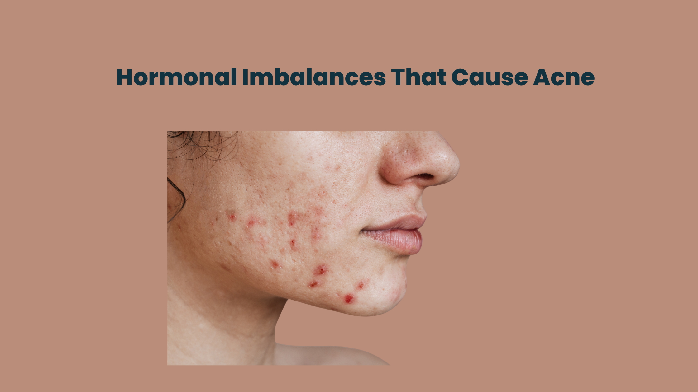 hormonal acne
