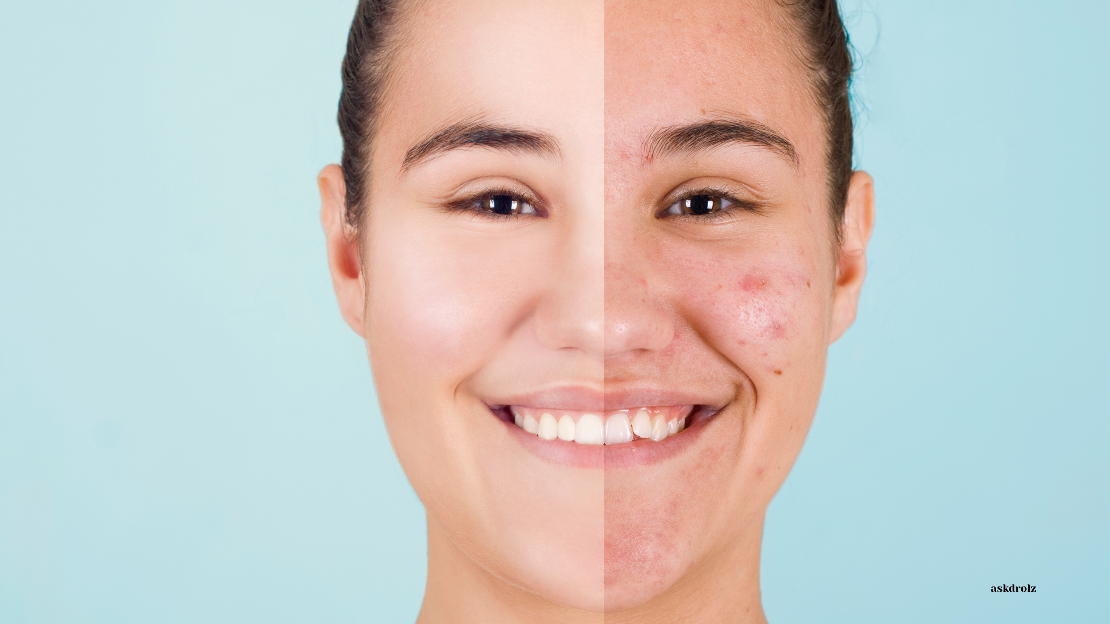 Hormonal acne, Hormonal acne treatment south africa