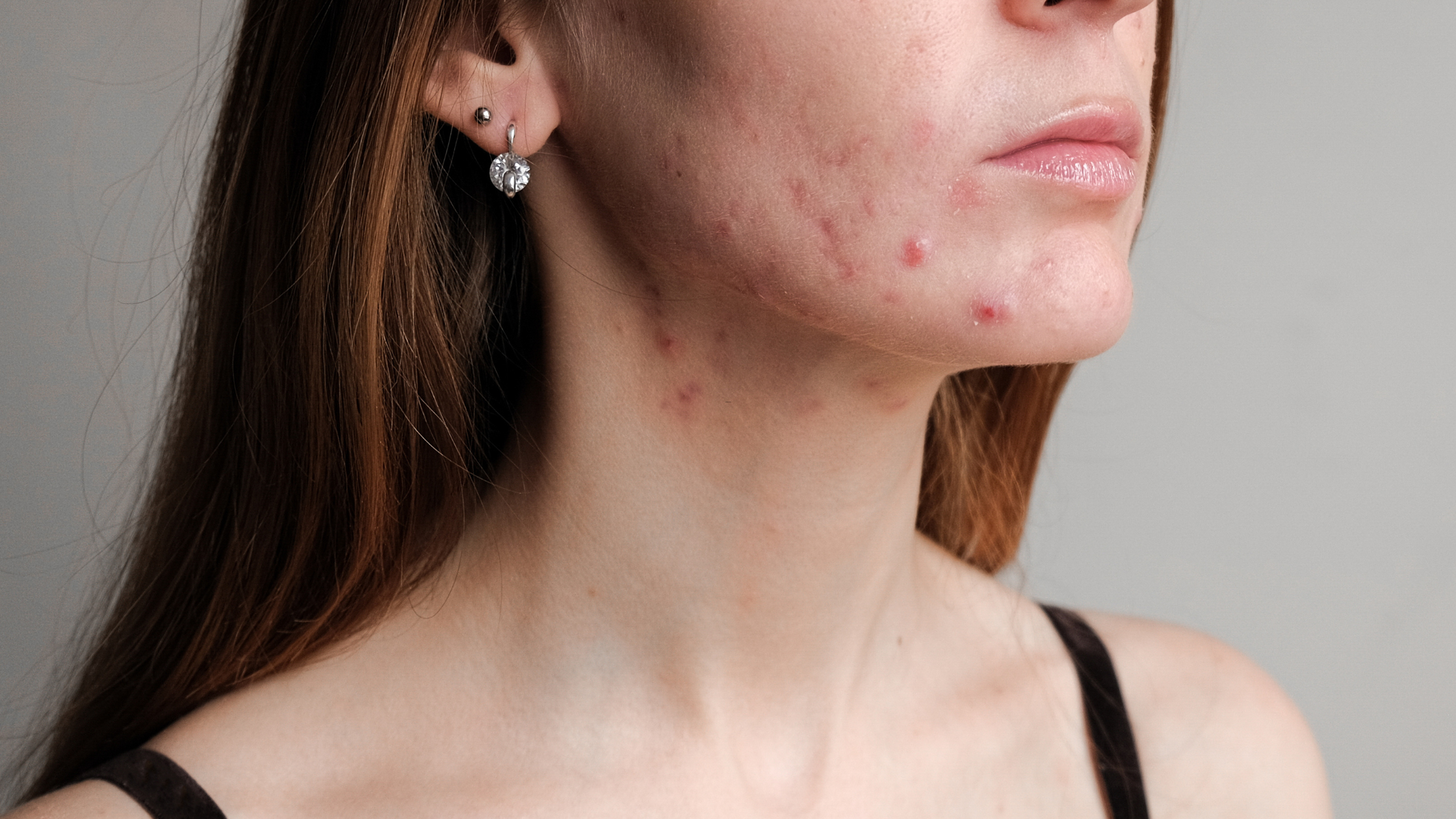 hormonal acne, hormonal acne treatment in south africa, hormonal pimples